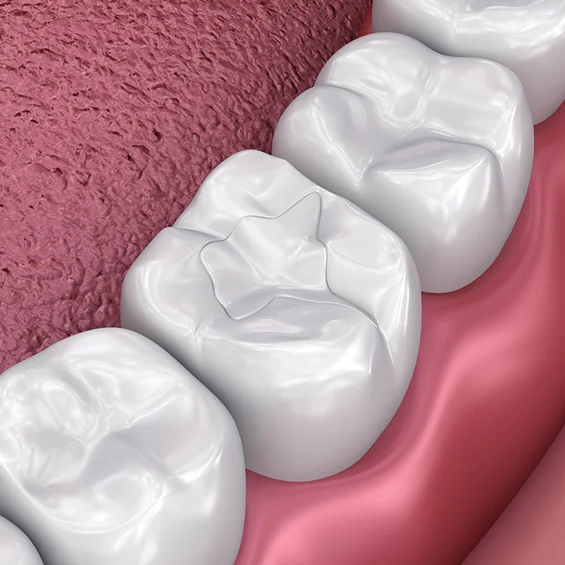 Three white dental crowns on pink gum model showing tooth restoration procedure