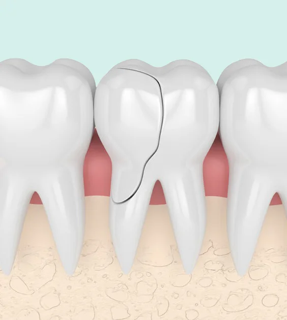 Anatomical diagram of teeth showing gum recession and dental structure layers for educational purposes.