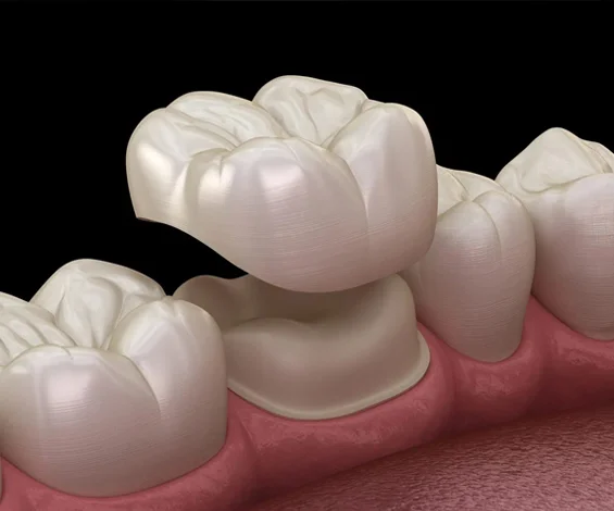 Dental crowns illustration showing tooth-colored ceramic restorations on pink gum model.