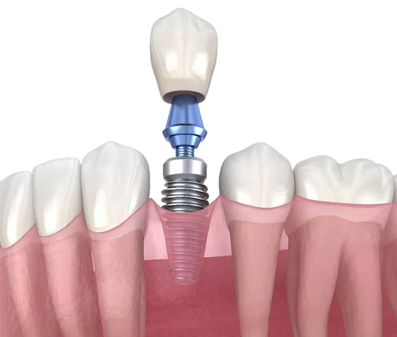 Dental implant diagram showing artificial tooth crown on titanium post among natural teeth and gums.