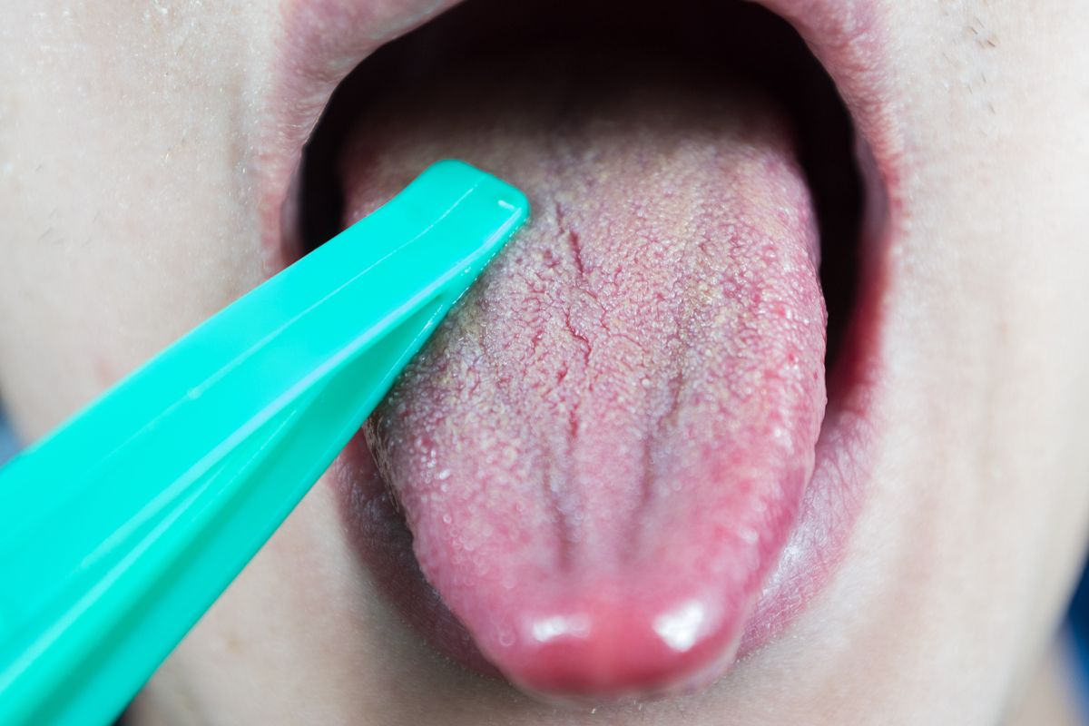 What Causes Your Tongue To Be So White