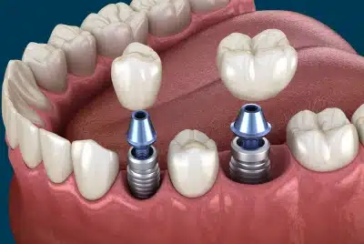 3D illustration of dental implant placement with crowns — Dental Care of Mid Florida, Sebring, FL.