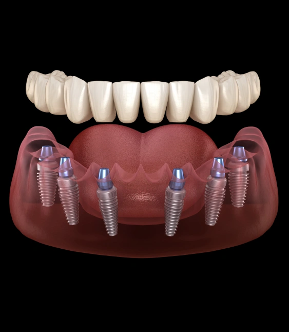 Permanent Tooth Replacement with All-on-X Implants