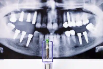 Dental implant model with panoramic X-ray in background — Dental Care of Mid Florida, Sebring, FL.