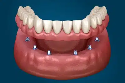 3D illustration of an implant-supported denture fitting over the lower jaw — Dental Care of Mid Florida, Sebring, FL.