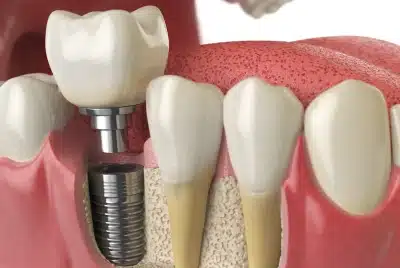 3D illustration of a dental implant healing and integrating with the jawbone — Dental Care of Mid Florida, Sebring, FL.