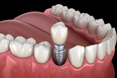 Implant Placement