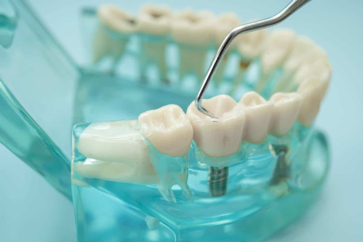 Composite Fillings in Sebring